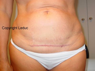 Cicatrice d'abdominoplastie1