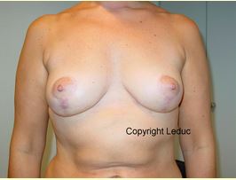Cicatrices et oedème sur reconstruction mammaire1